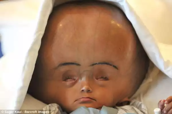 Little Indian Girl With Rare Swollen Head Dies Days After Life-Changing Surgery. Photos